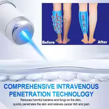 Stylo Laser Thérapeutique Soulagement & Bien-être des Jambes